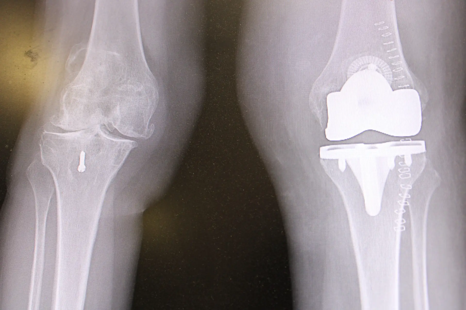 Knee replacement xray